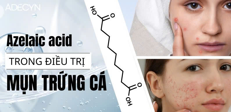 Azelaic Acid trong điều trị Mụn trứng cá