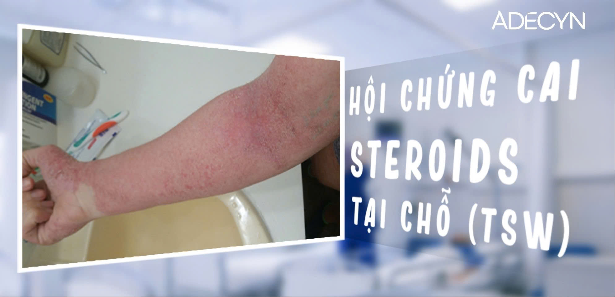 Hội chứng cai Steroids tại chỗ (TSW)