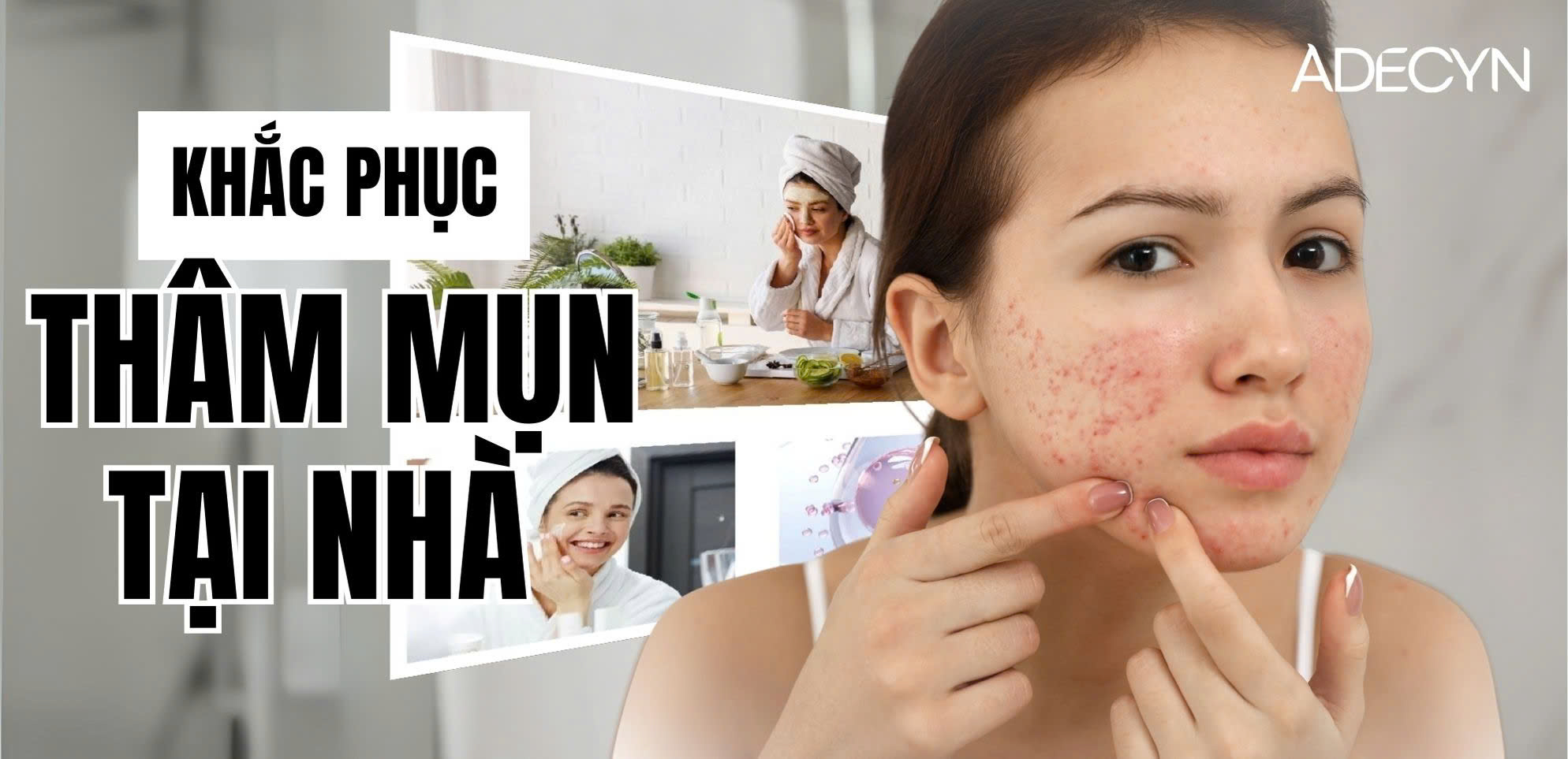 Cách khắc phục thâm mụn tại nhà