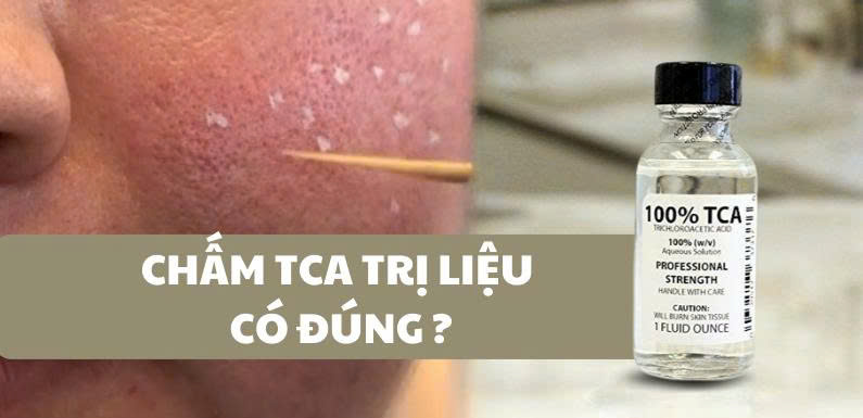Chấm TCA trị nám liệu có đúng ?