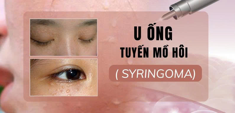 U ống tuyến mồ hôi ( Syringoma)