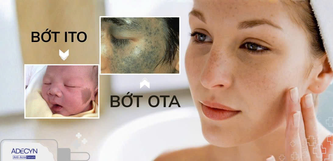 Bớt Ota và bớt Ito