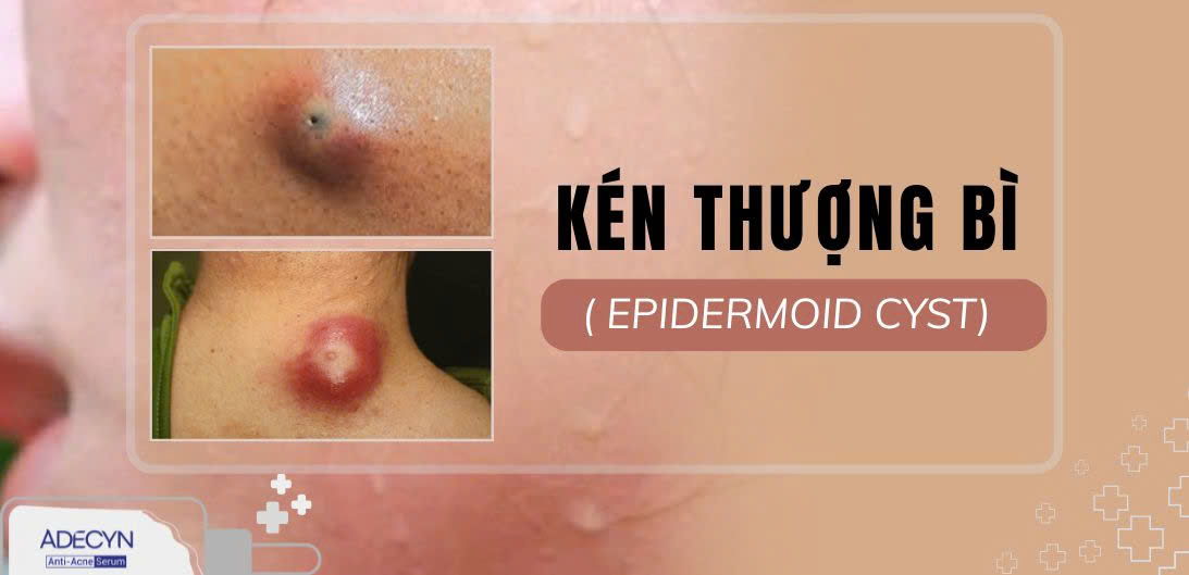 Kén thượng bì ( Epidermoid cyst)