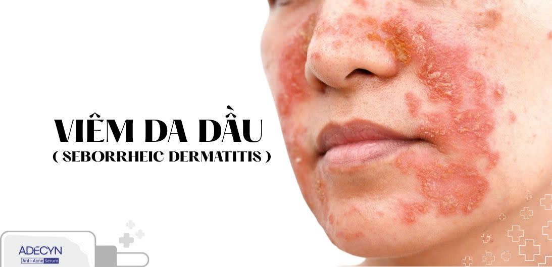 Viêm da dầu ( Seborrheic Dermatitis )