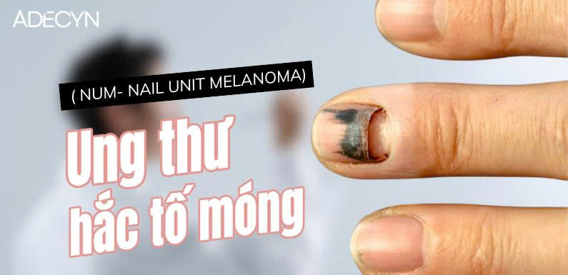 Ung thư hắc tố móng ( NUM- Nail unit melanoma)