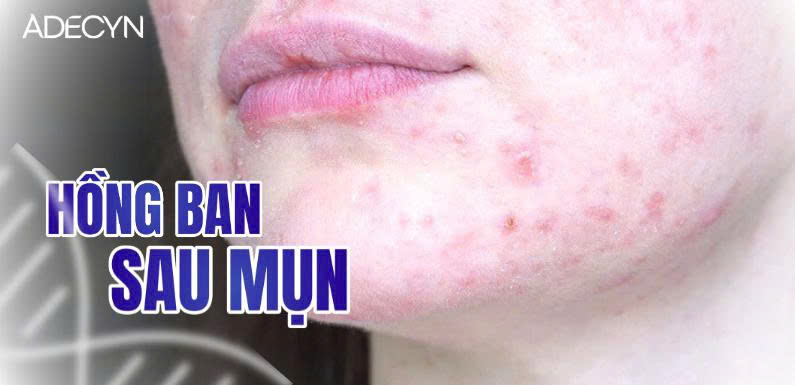 Hồng ban sau mụn