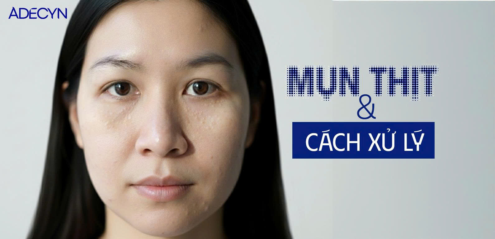 Mụn thịt và cách xử lý