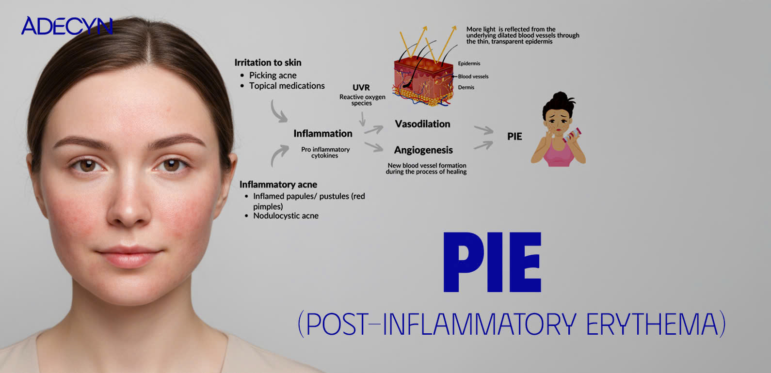 PIE (Post-Inflammatory Erythema)