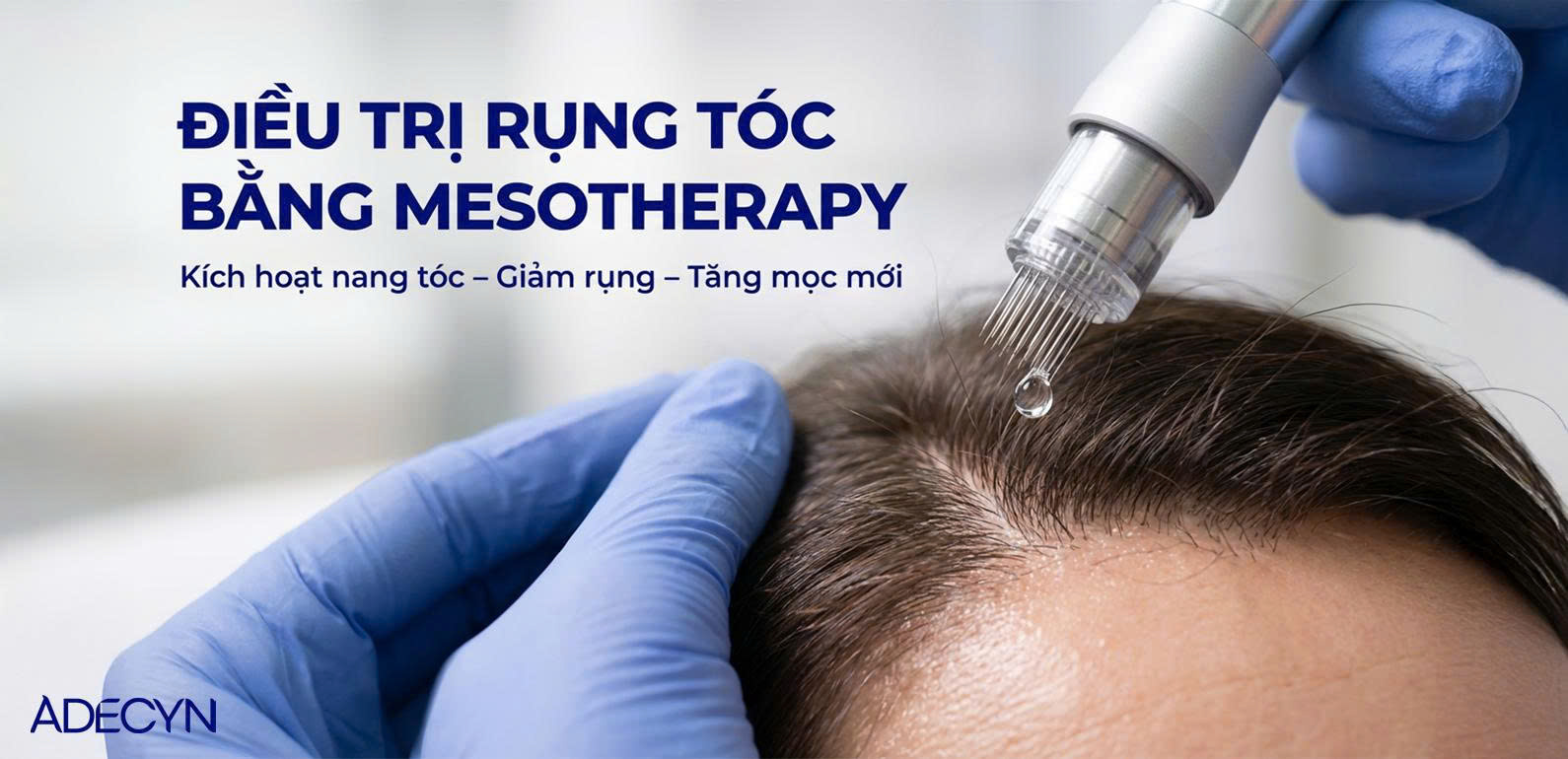Điều trị rụng tóc bằng mesotherapy