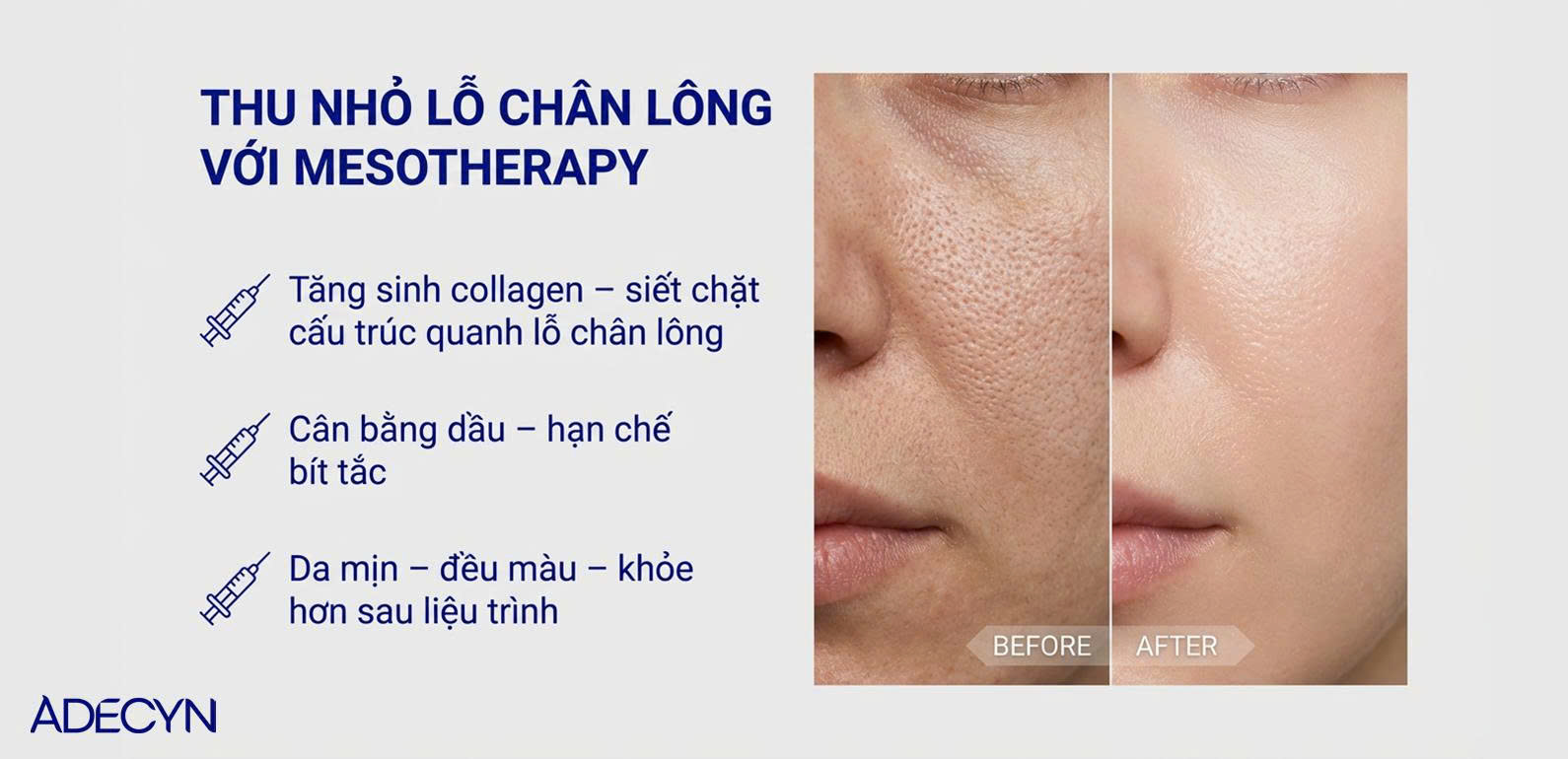 Thu nhỏ lỗ chân lông với Mesotherapy