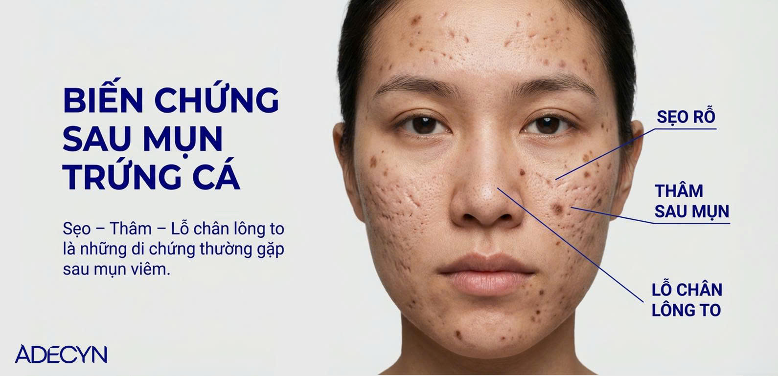 Biến chứng sau mụn trứng cá