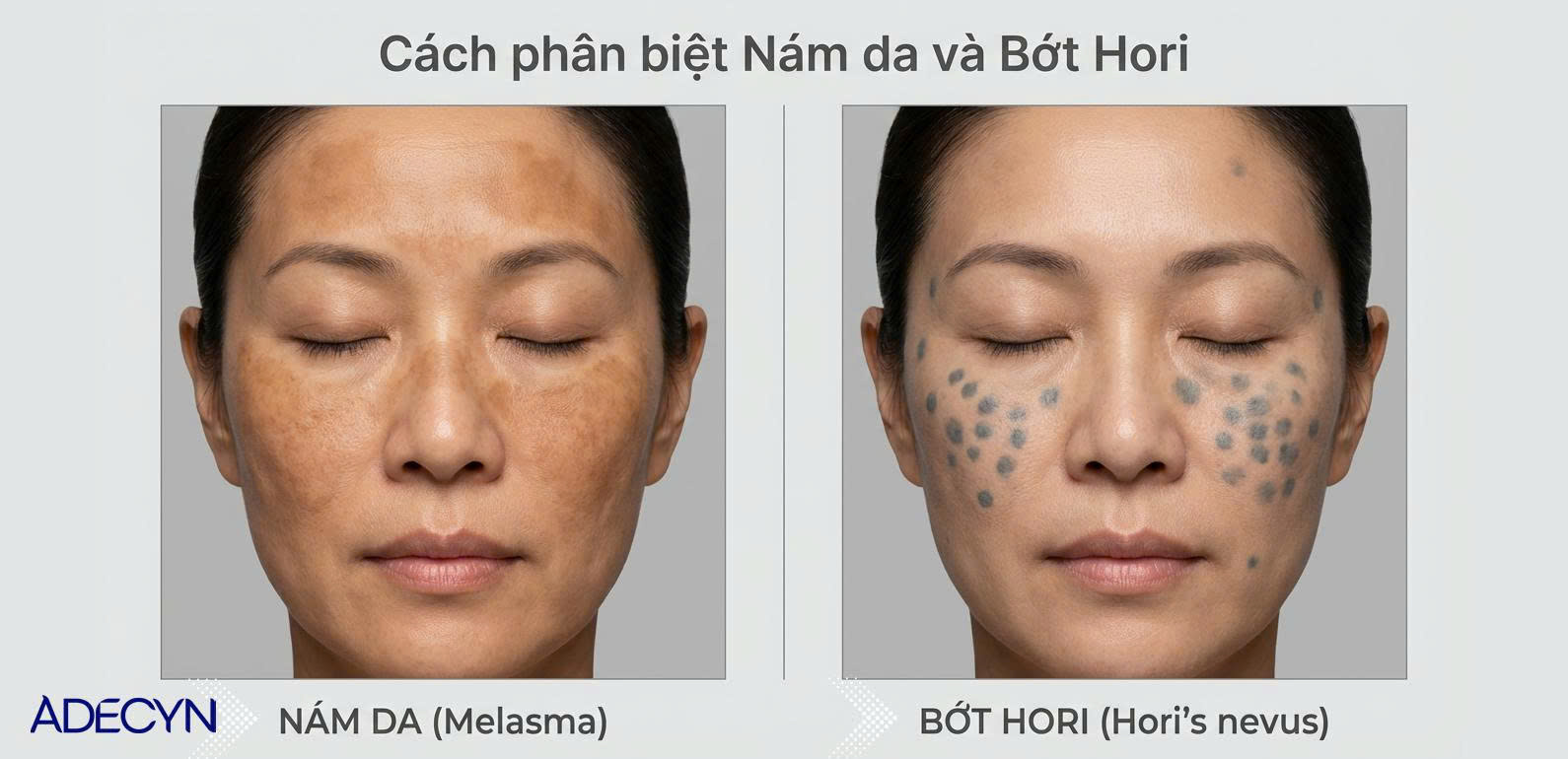 Cách phân biệt nám và bớt Hori