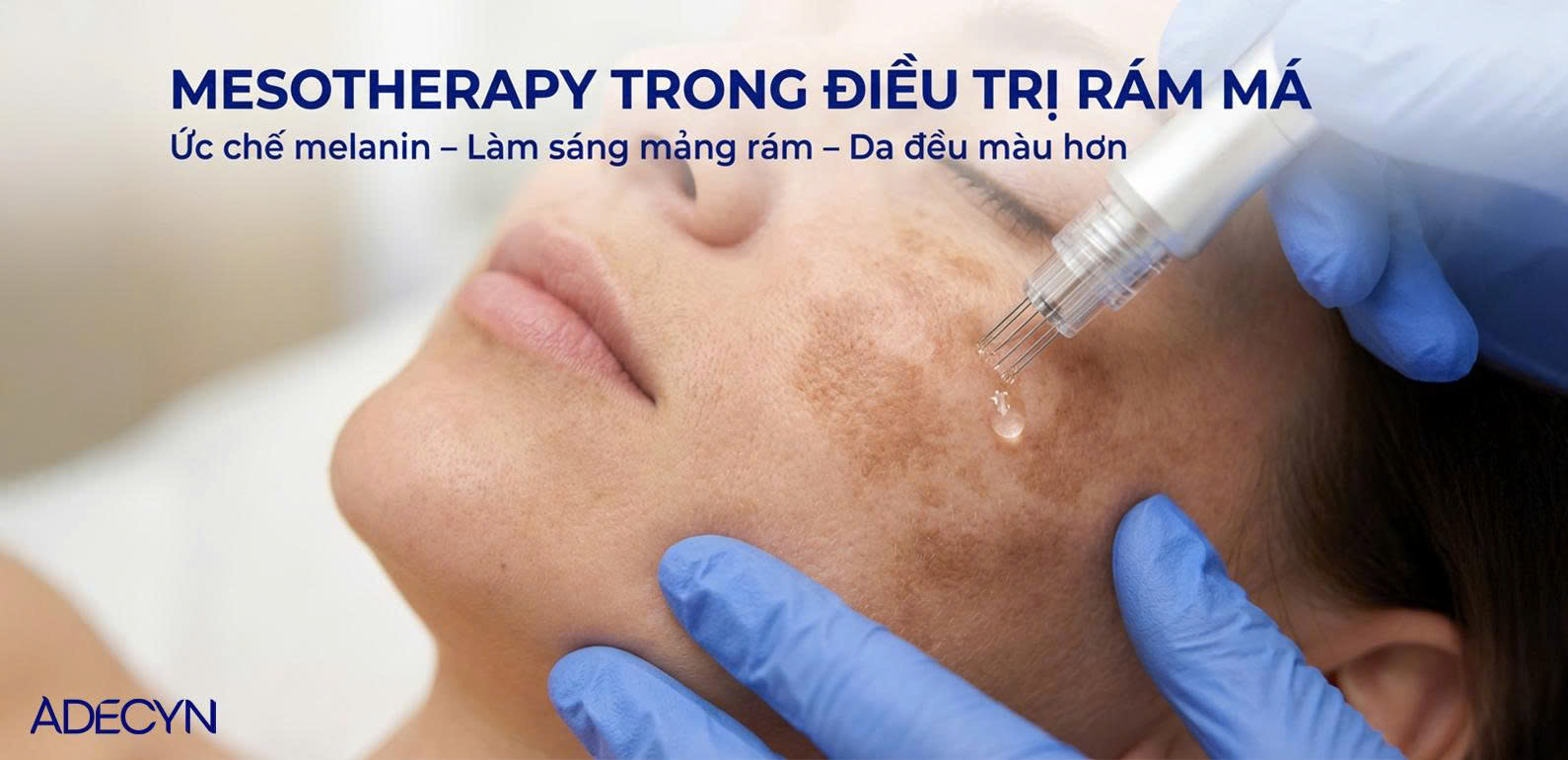 Mesotherapy trong điều trị rám má
