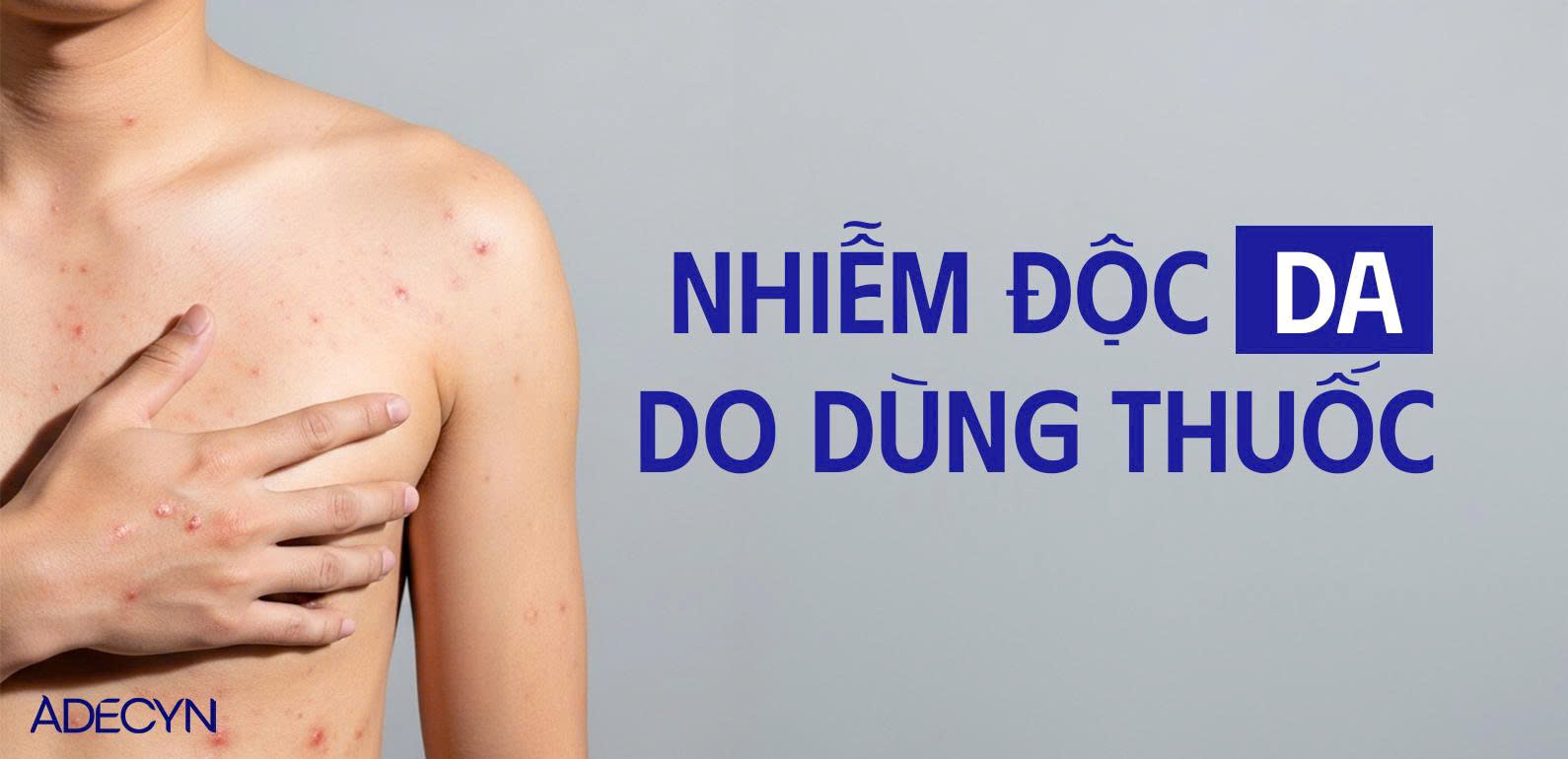 Nhiễm độc da do dị ứng thuốc