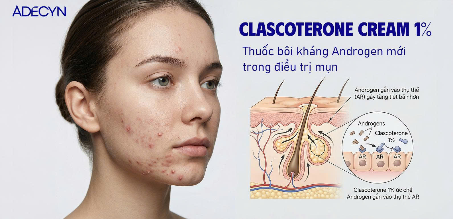 CLASCOTERON CREAM 1%- THUỐC BÔI KHÁNG ANDROGEN MỚI TRONG ĐIỀU TRỊ MỤN