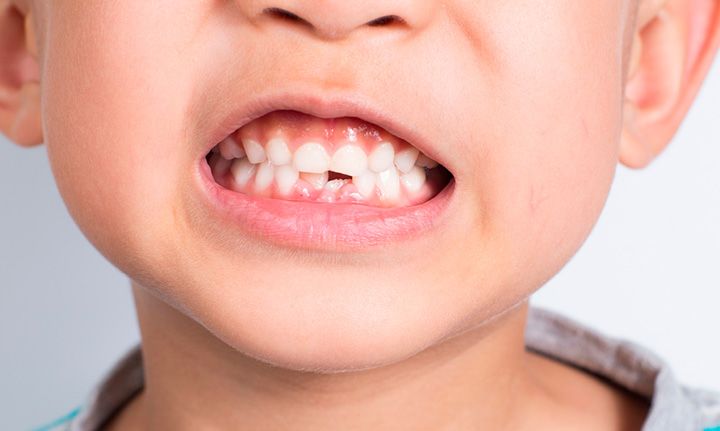 5 thói quen xấu khiến răng bạn nhanh hỏng