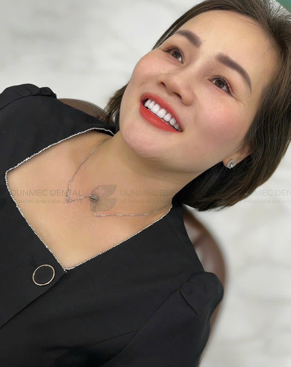 CẤU TẠO CỦA RĂNG IMPLANT – GIẢI PHÁP HOÀN HẢO CHO NGƯỜI MẤT RĂNG