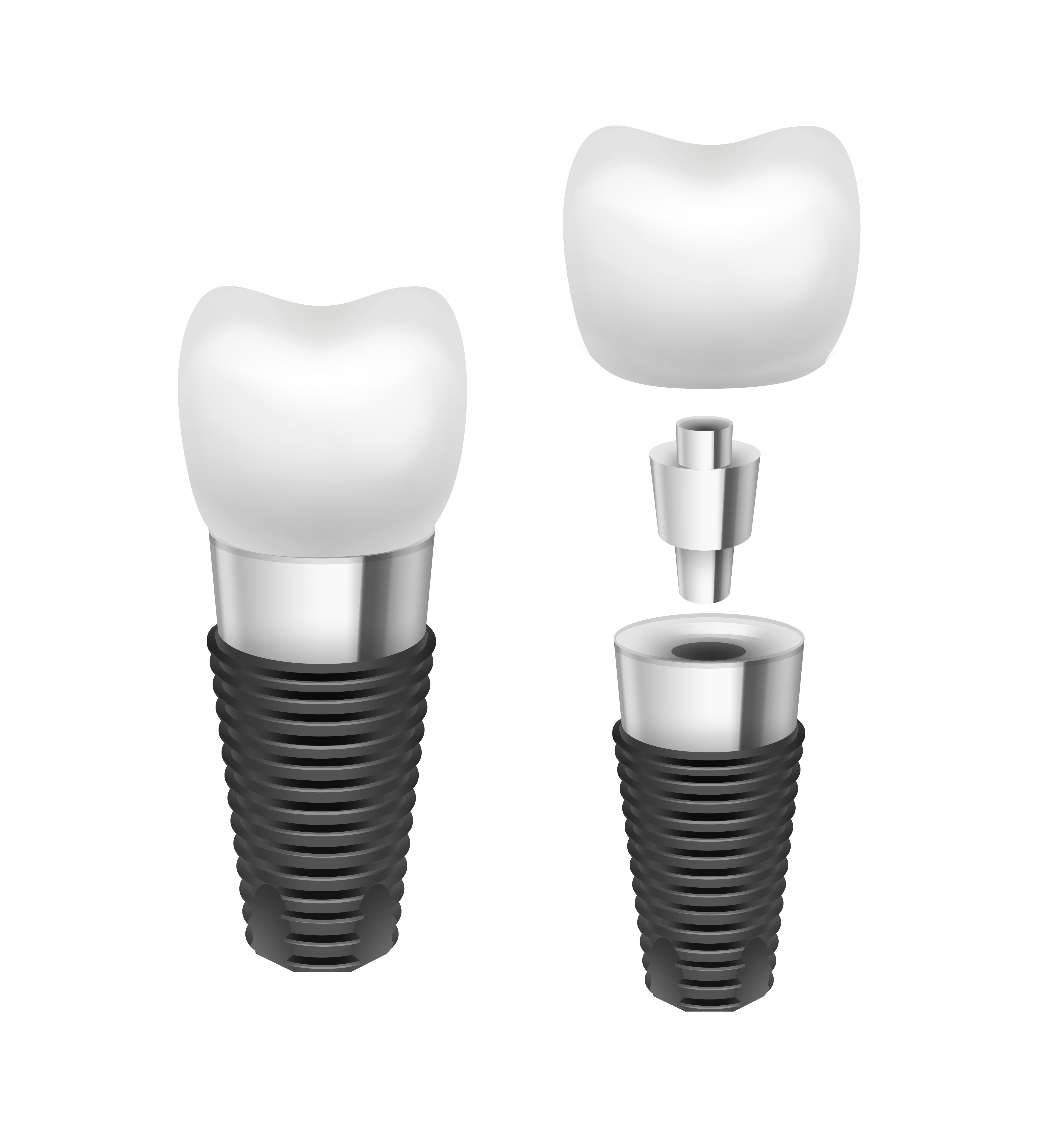 Implant Mini Là Gì? Khác Biệt Với Implant Thường – Phân Tích Chi Tiết Từ Chuyên Gia