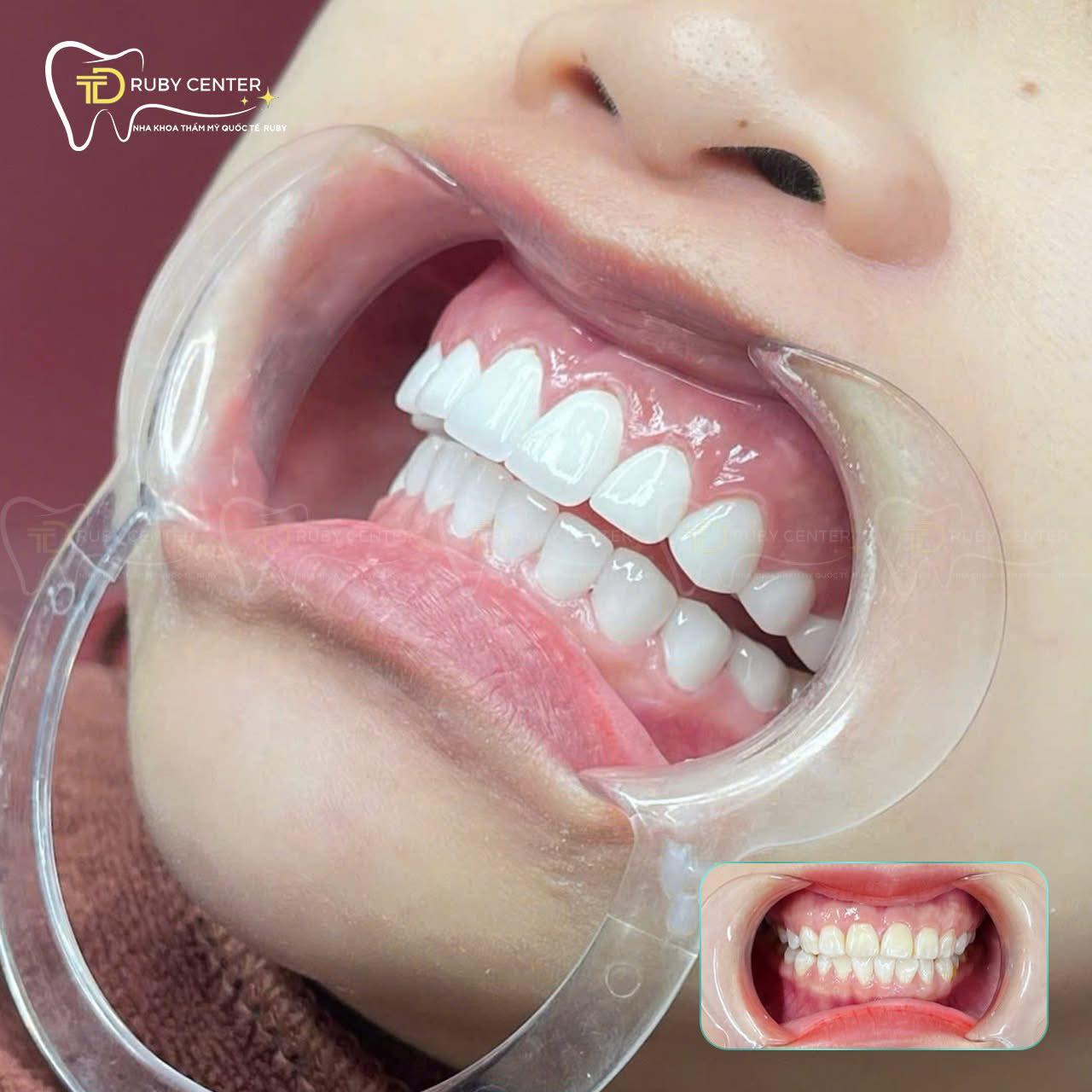NÂNG TẦM NỤ CƯỜI – TỎA SÁNG MỌI KHOẢNH KHẮC