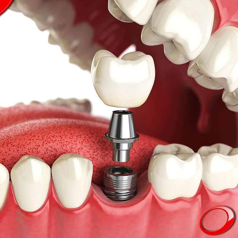 Trồng răng Implant: Lựa chọn thông minh cho nụ cười bền vững