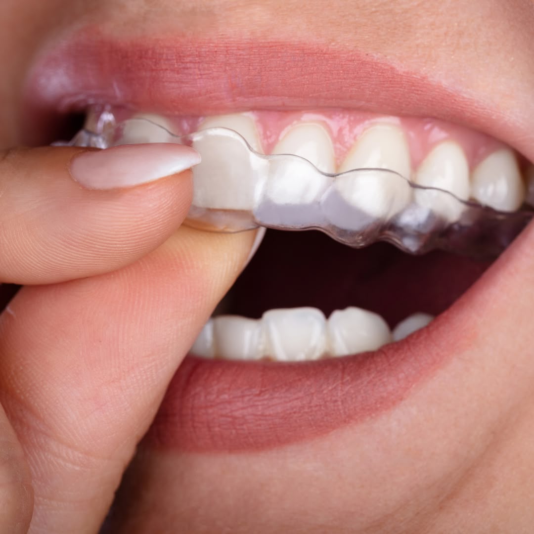 Niềng răng trong suốt Invisalign: Giải pháp chỉnh nha hiện đại với ưu và nhược điểm cần biết