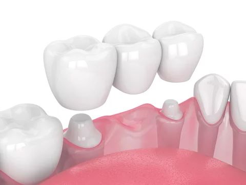 So sánh cầu răng sứ và trồng răng Implant: Giải pháp phục hình răng nào tốt hơn
