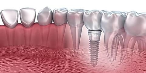 Khi mất răng, đừng ngại cười – Implant sẽ giúp bạn lấy lại tất cả!