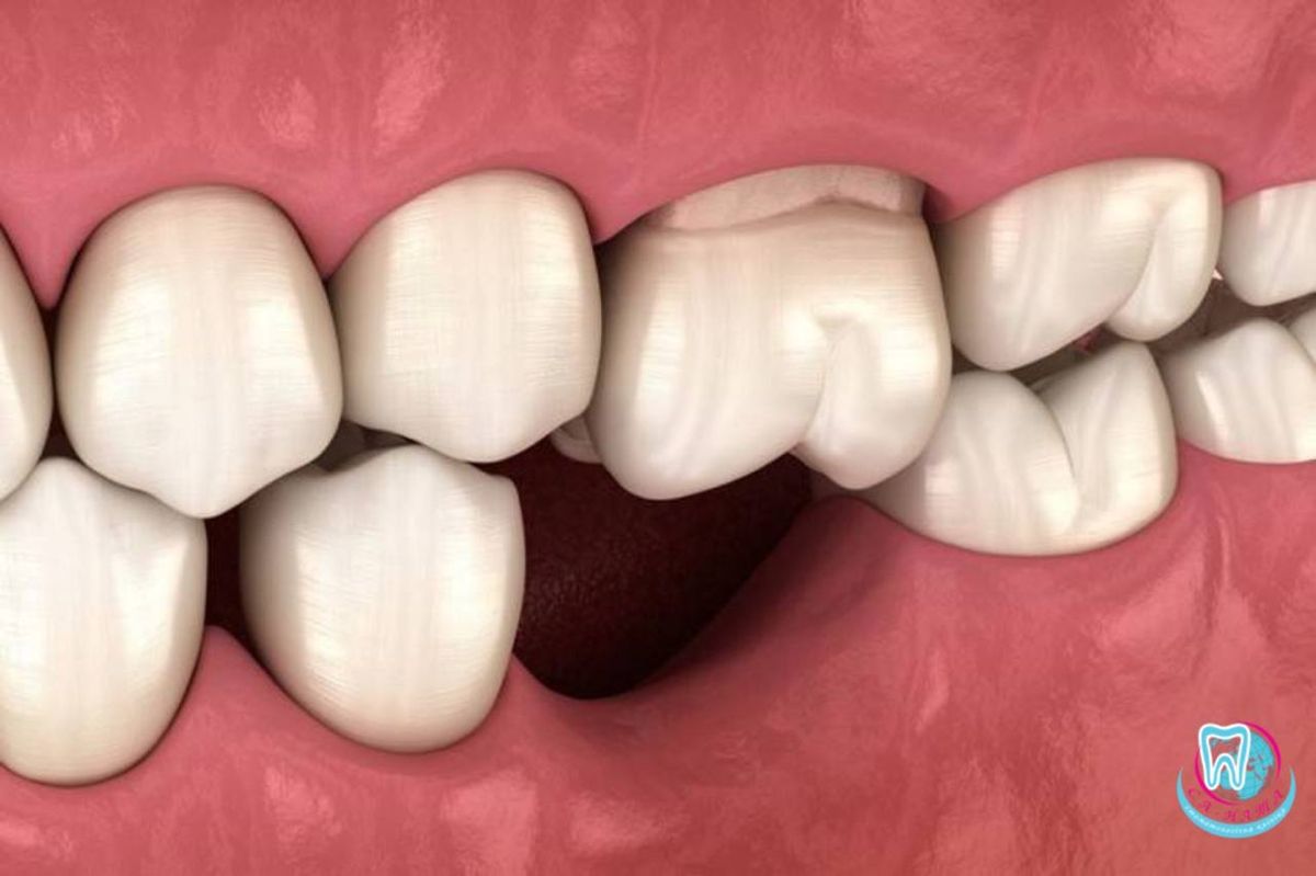 Implant – Giải pháp phục hồi răng mất số 1: Bền chắc, thẩm mỹ và ngăn ngừa tiêu xương