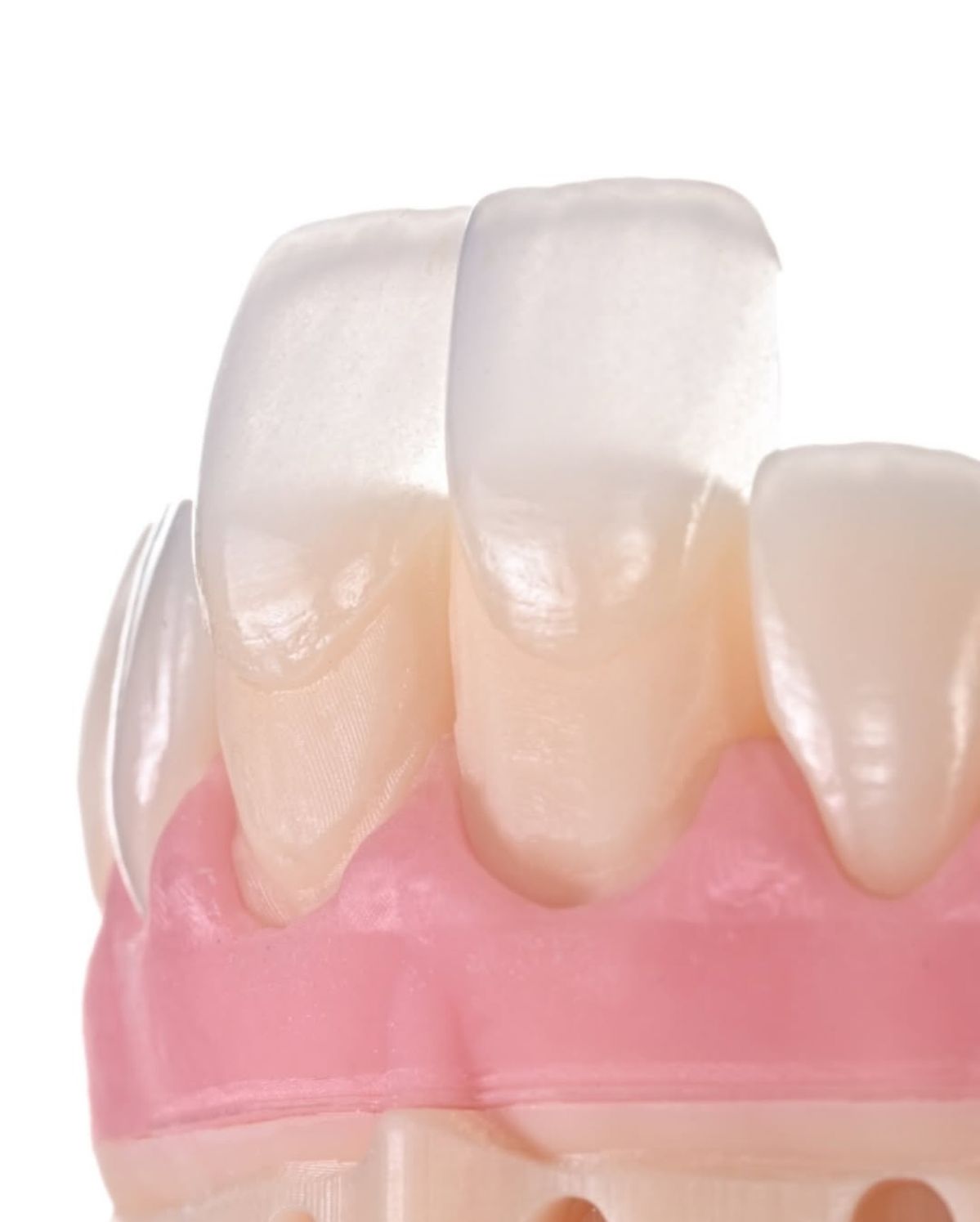 Dán Sứ Veneer – Giữ Trọn Răng Thật, Nâng Tầm Nụ Cười Sang Trọng