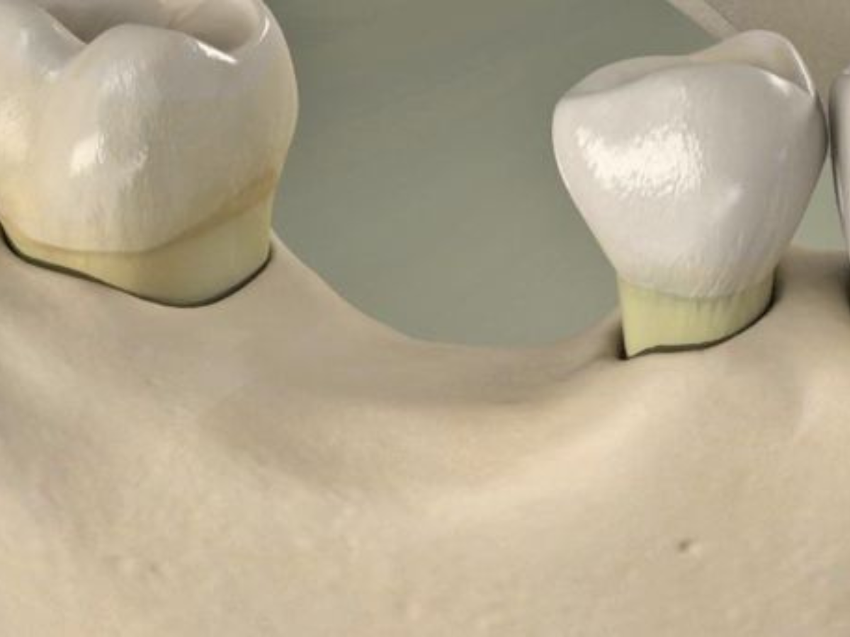 Trồng răng Implant quá trễ: Những biến chứng nguy hiểm bạn không nên bỏ qua