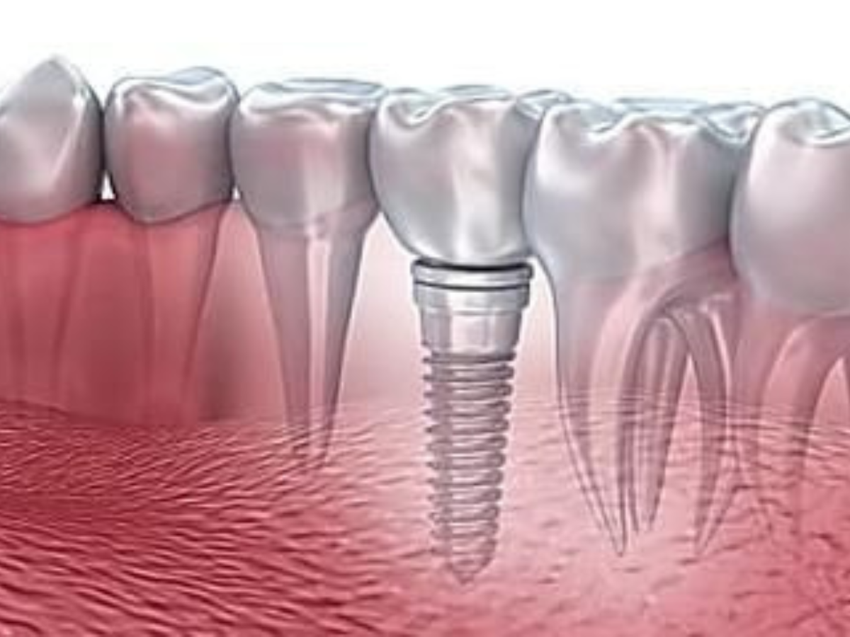 Hối hận khi trồng Implant giá rẻ: Những rủi ro có thể gặp phải