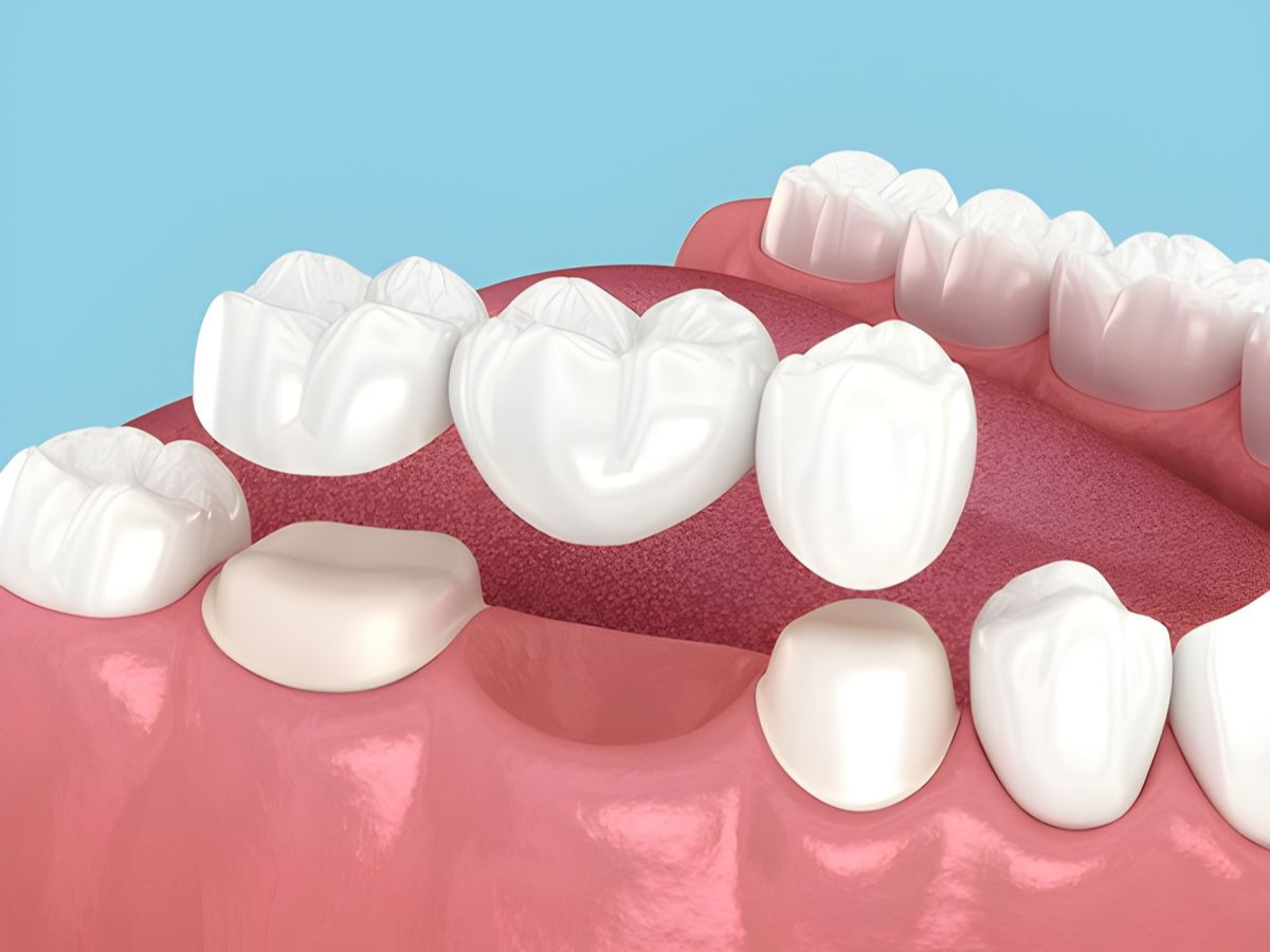 Trồng răng Implant và khắc phục cầu răng sứ như thế nào? Giải pháp phục hồi răng mất hiệu quả