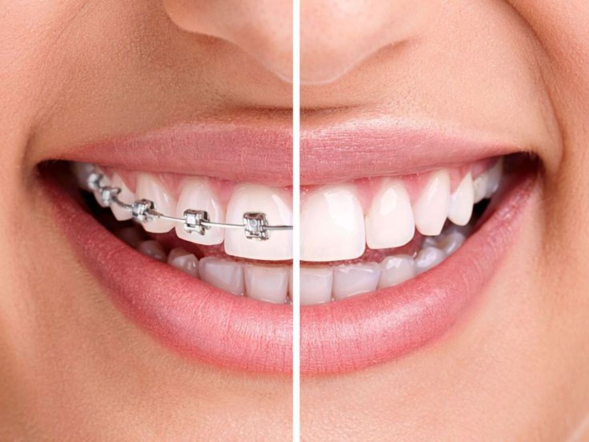 Niềng răng là gì? Lợi ích, quy trình và những điều cần biết trước khi chỉnh nha