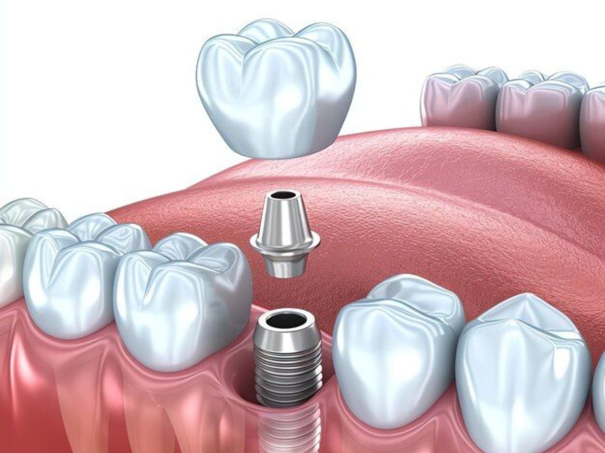 Trồng răng Implant có thể gây ra những biến chứng nào? Những điều cần biết trước khi thực hiện