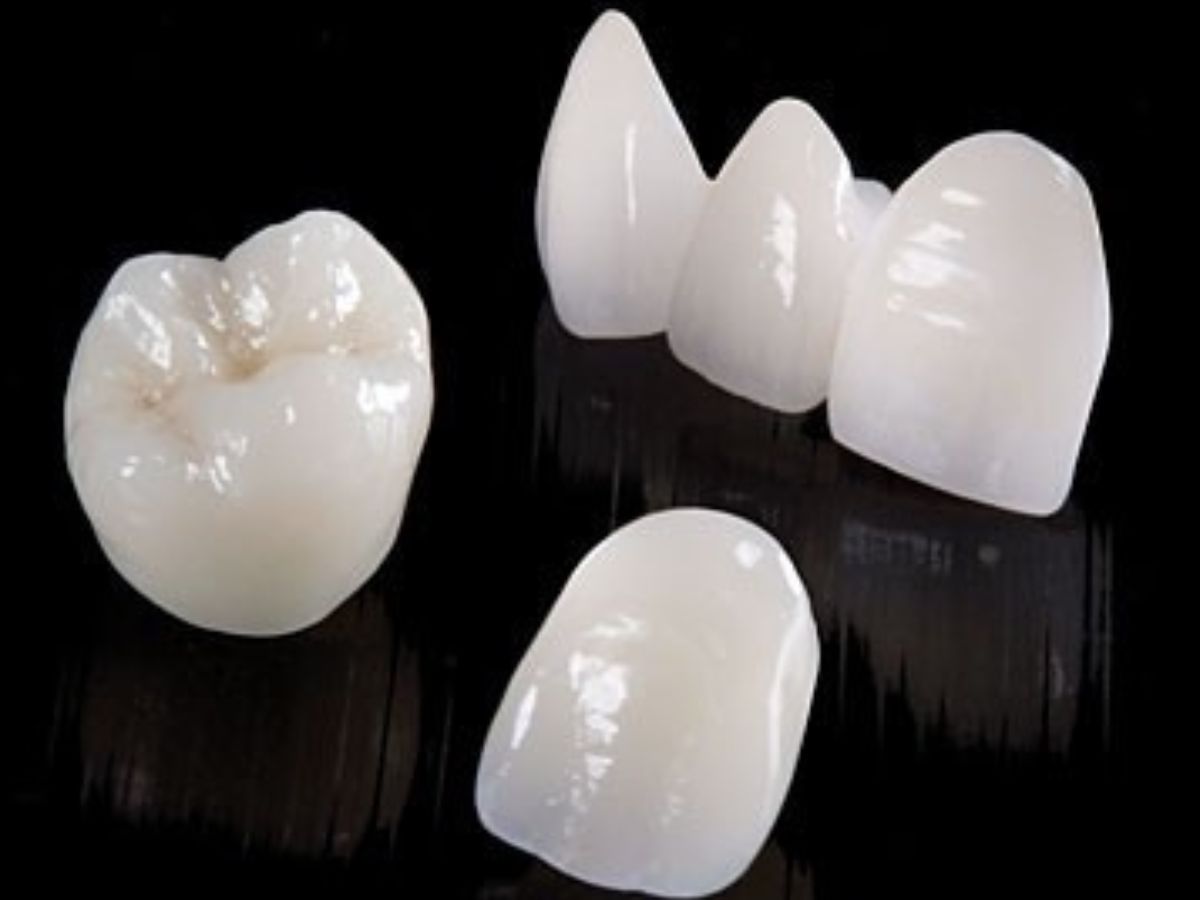 Răng sứ không kim loại giá bao nhiêu, loại nào tốt? Ưu nhược điểm cần biết