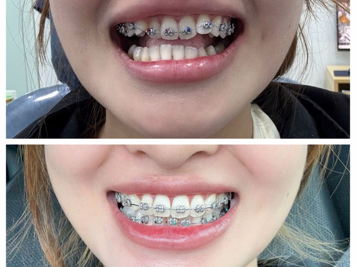 Niềng răng 365 ngày: Hành trình thay đổi nụ cười và sự tự tin