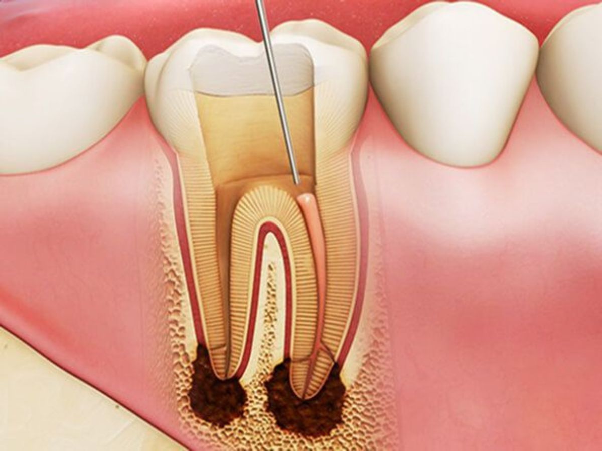 Răng chưa lấy tủy có niềng răng được không? Giải đáp chi tiết từ chuyên gia