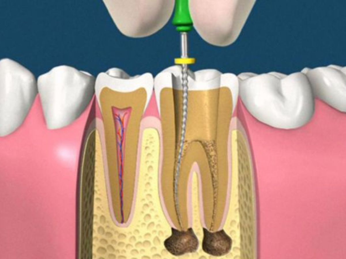 Viêm tủy răng: Nguyên nhân, triệu chứng và cách khắc phục hiệu quả