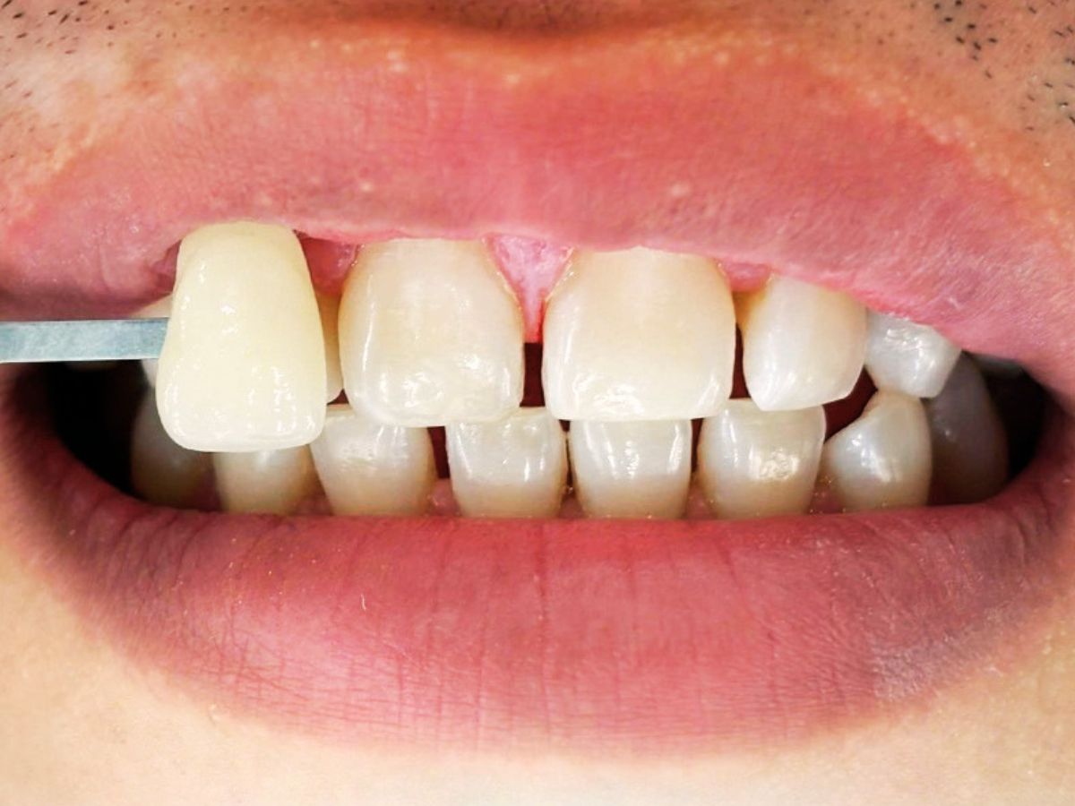 Tổng hợp các dịch vụ nha khoa tại DUNMEC – Giải pháp chăm sóc và thẩm mỹ nụ cười toàn diện