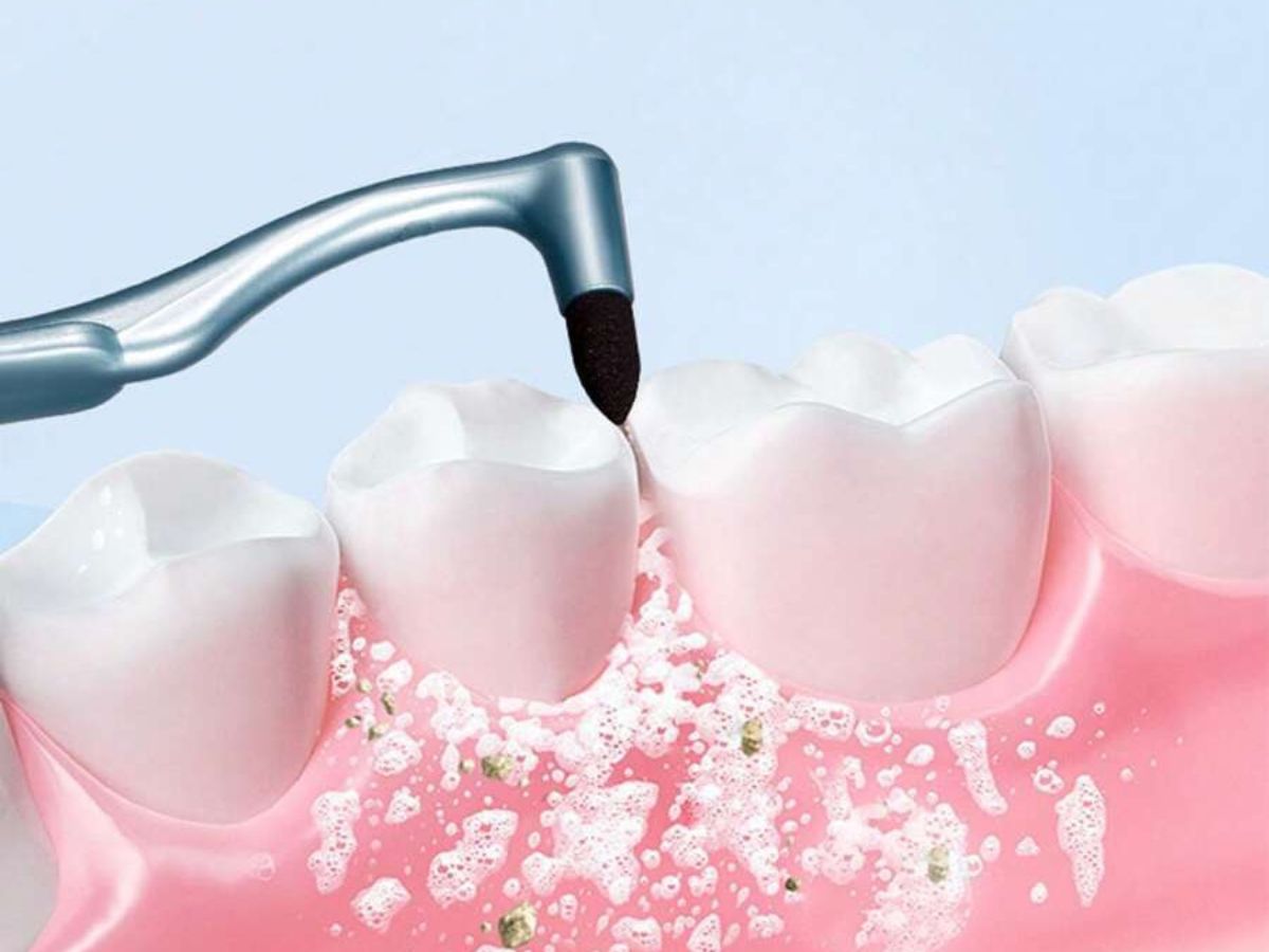 Cao răng là gì? Hình thành như thế nào, tác hại và cách ngăn ngừa