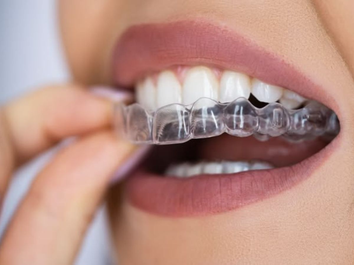 Niềng răng 3D – Giải pháp cho hàm răng đẹp tự nhiên