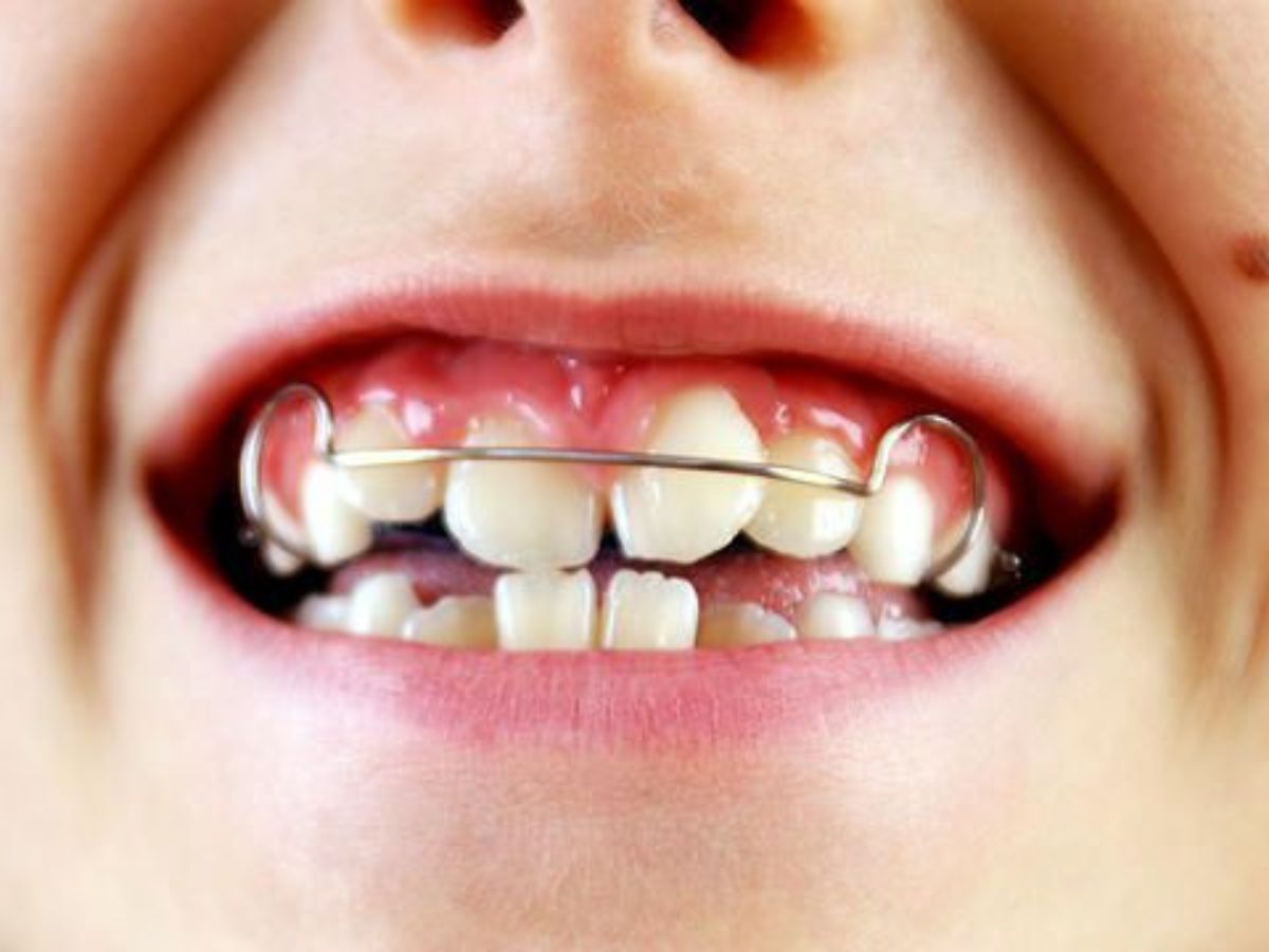 Răng vẩu là gì? Các loại răng vẩu thường gặp và cách khắc phục hiệu quả