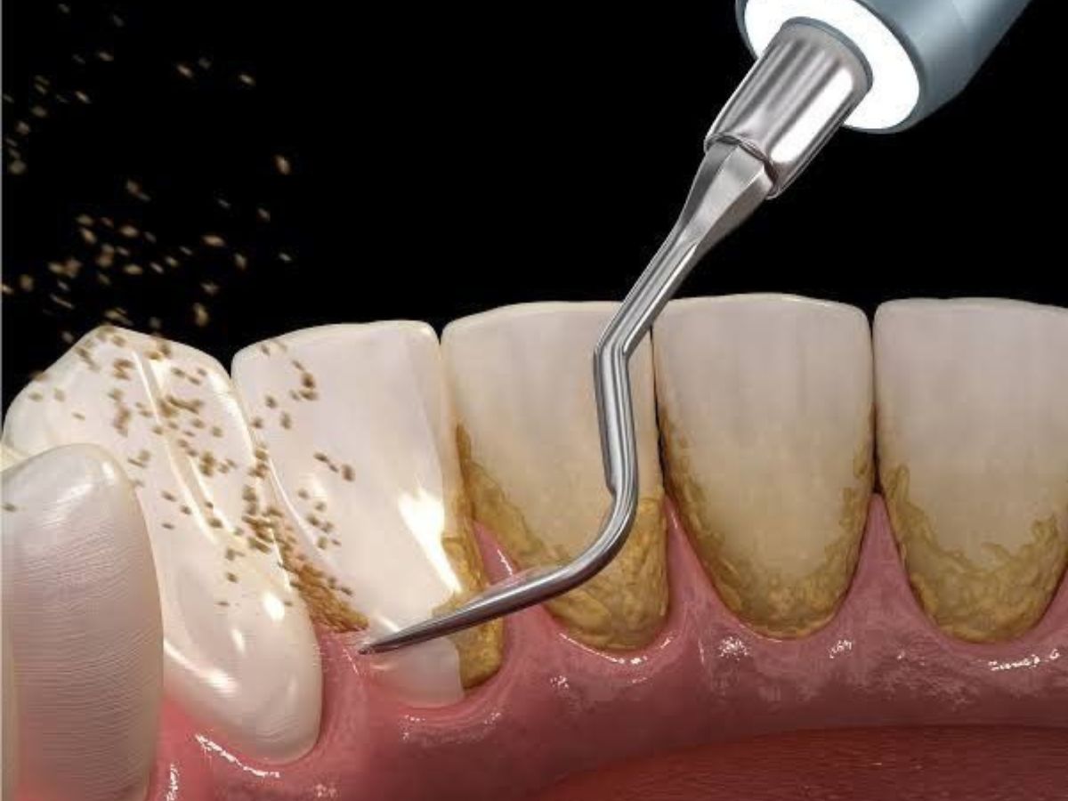 Răng bị đen ở mặt trong do đâu? Nguyên nhân và cách khắc phục hiệu quả