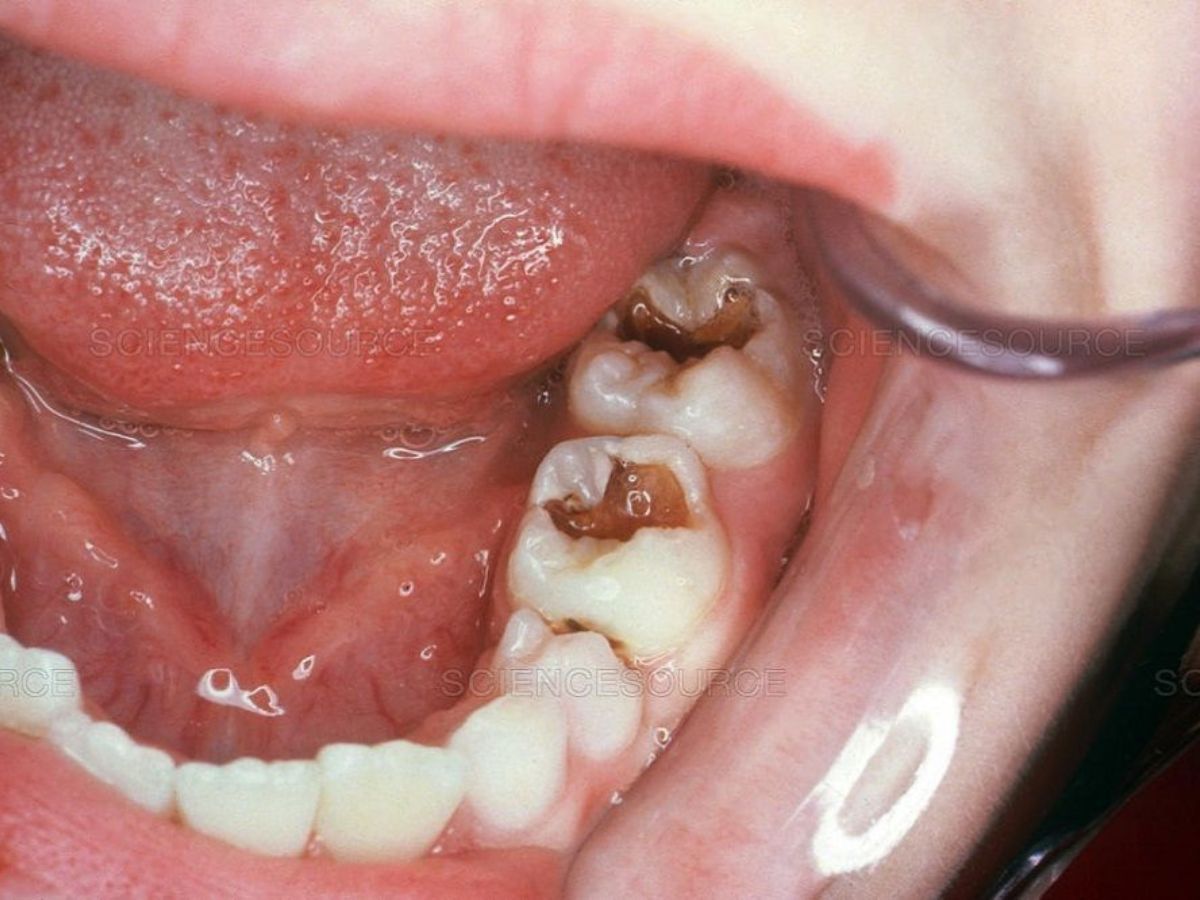 8 cách trị nhức răng có lỗ ngay tại nhà đơn giản mà hiệu quả