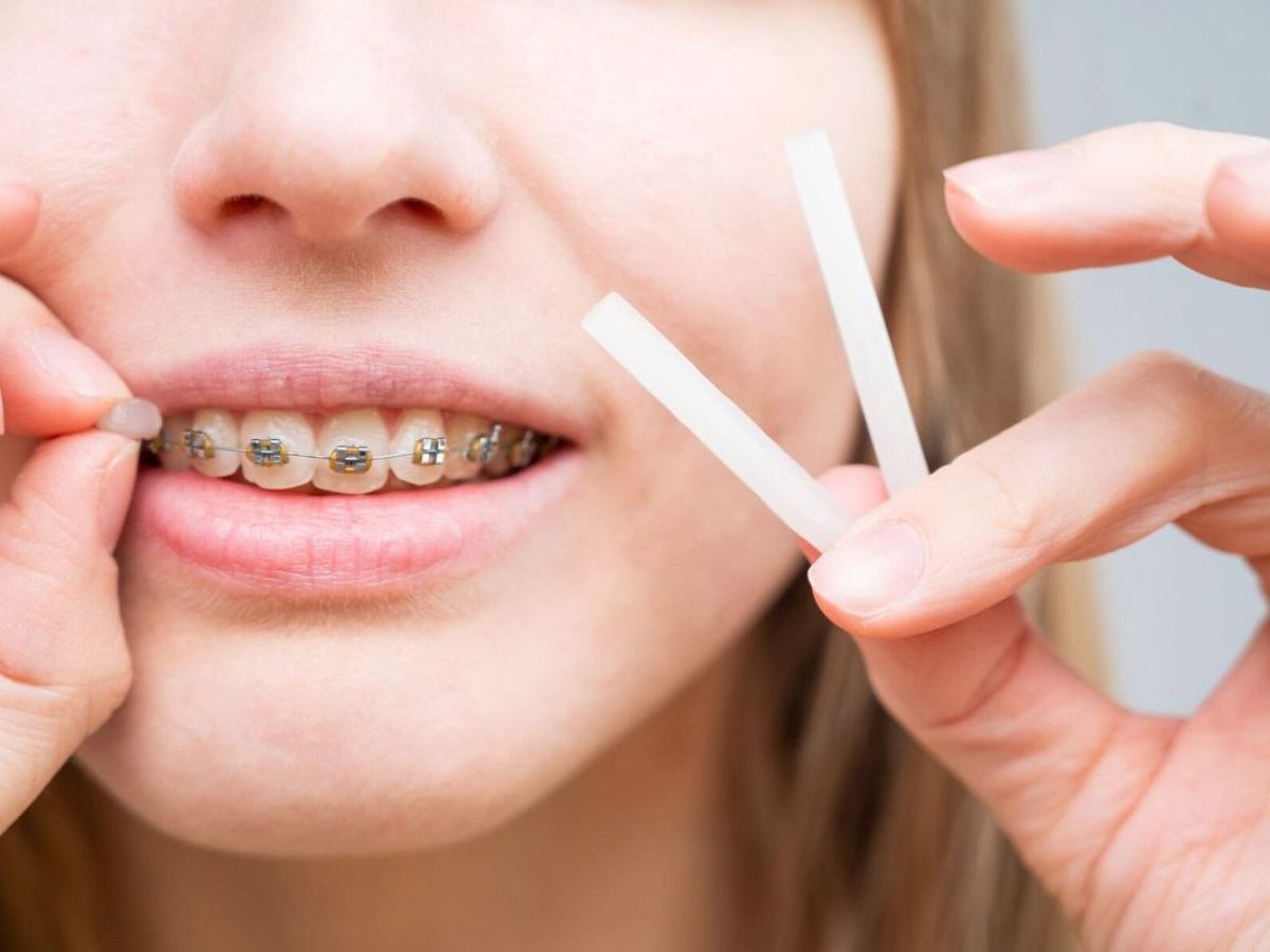 Sáp nha khoa là gì? Hướng dẫn cách dùng sáp nha khoa hiệu quả