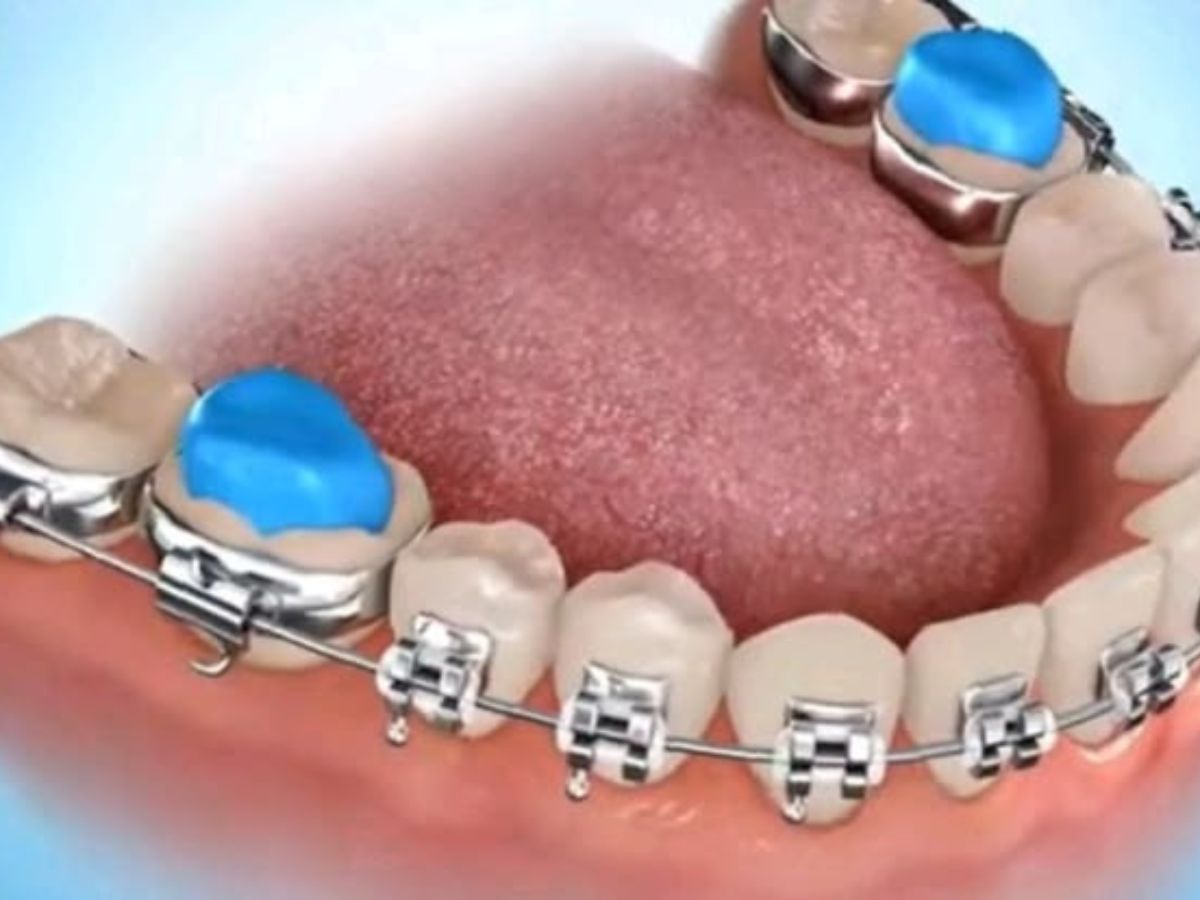 Tác dụng của nâng khớp cắn trong niềng răng là gì?