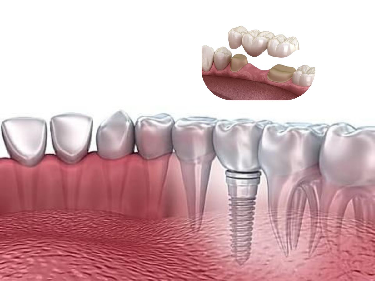 So sánh trồng răng Implant và cầu răng sứ: Nên chọn phương pháp nào?