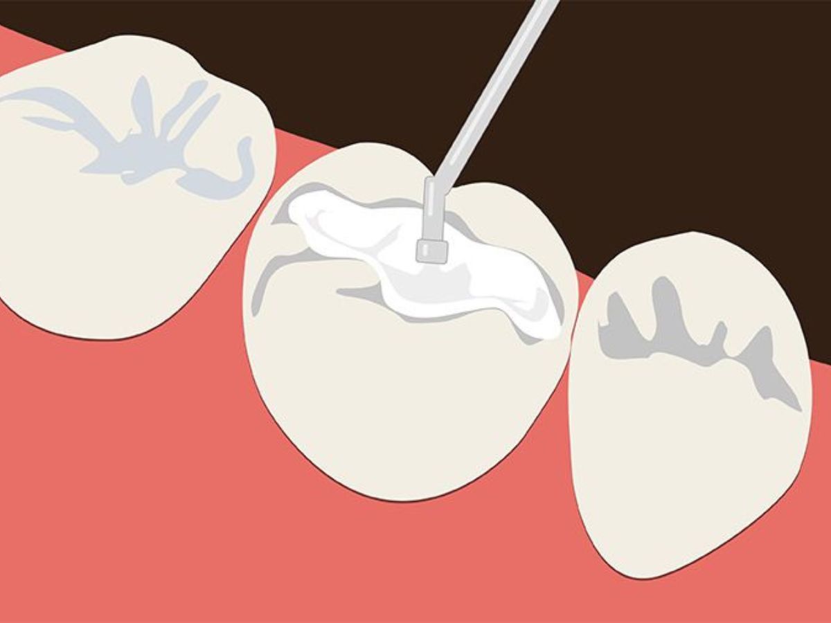 Trám răng sâu là gì? Khi nào nên trám răng để bảo vệ răng hiệu quả