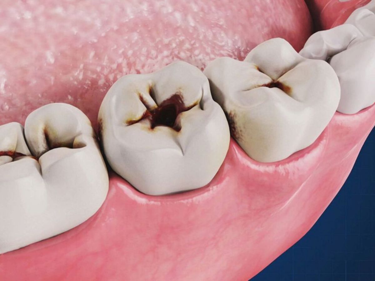 Những trường hợp cần trám răng để bảo tồn răng thật hiệu quả