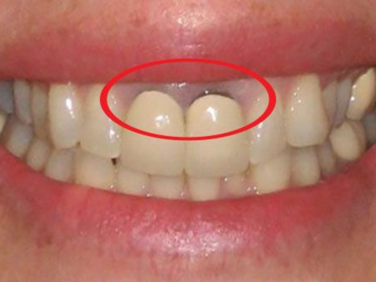 Hậu quả của làm răng sứ giá rẻ: 7 rủi ro nghiêm trọng bạn cần biết trước khi quyết định